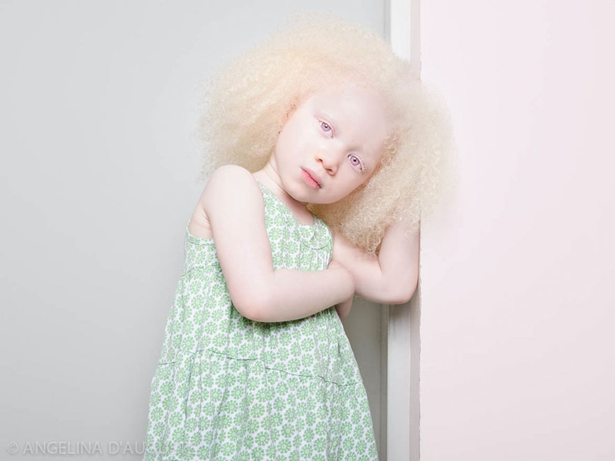 krasa-albinstva10