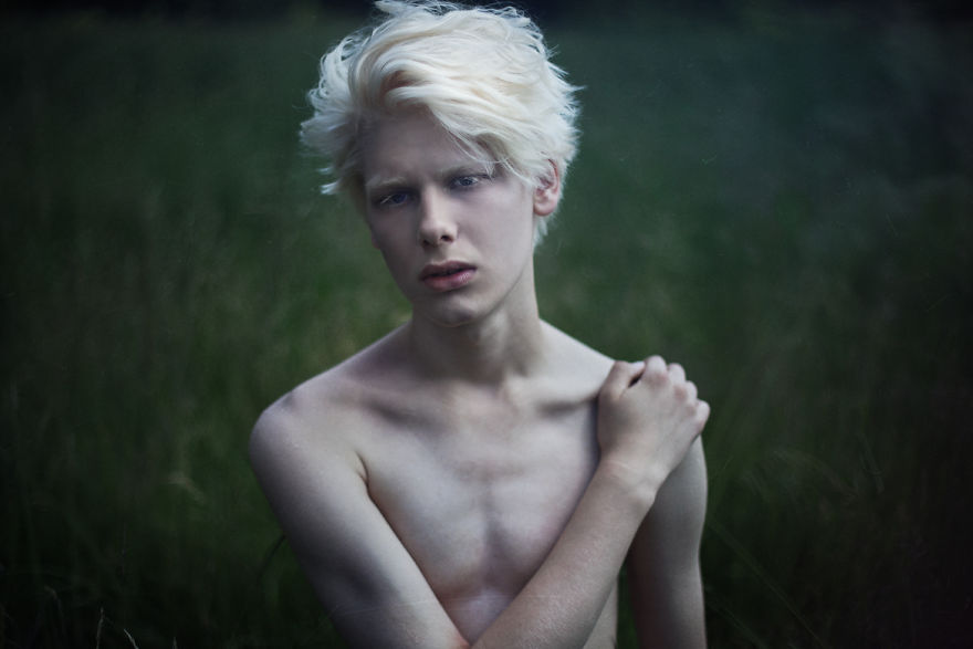 krasa-albinstva15