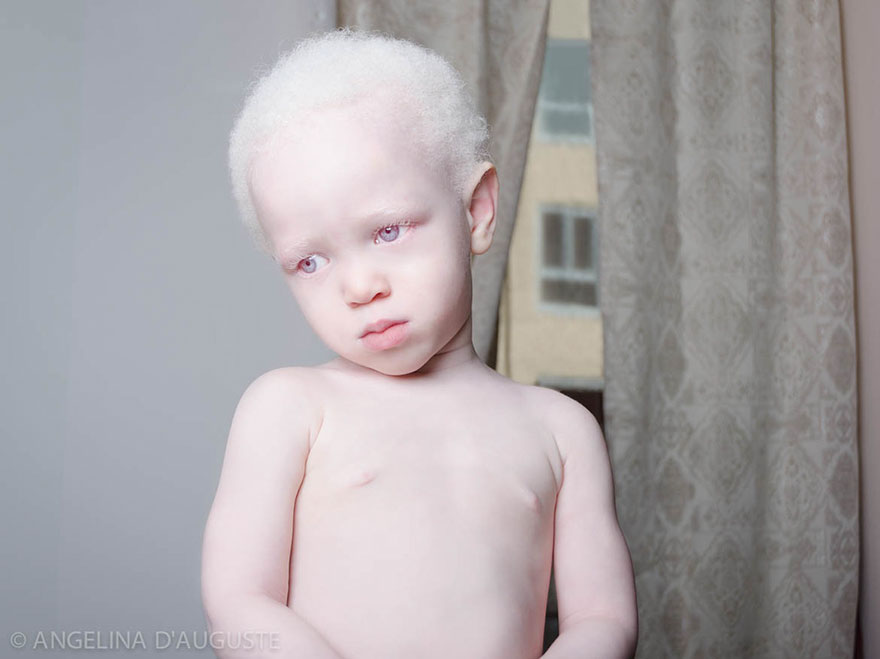 krasa-albinstva4