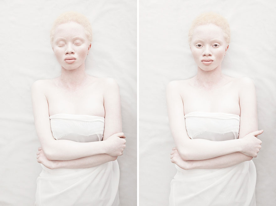 krasa-albinstva6