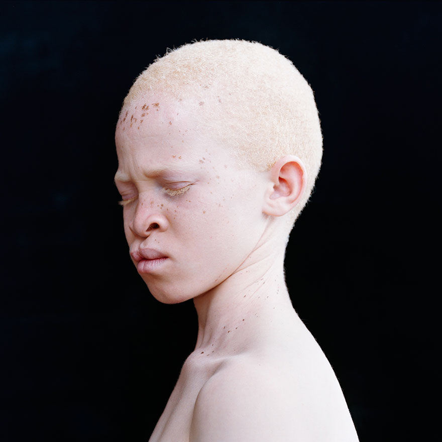 krasa-albinstva8