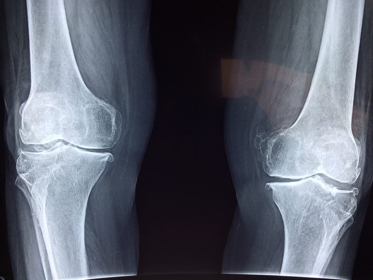 knee-2253047_1280-770x578