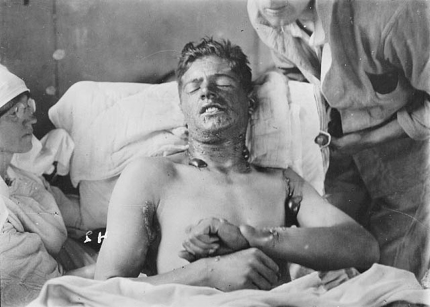 mustard_gas_burns