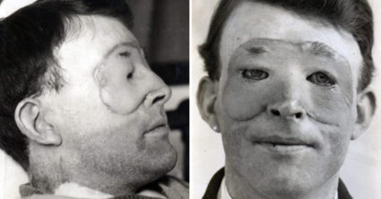 Začiatky plastickej chirurgie: Lekár mužovi na tvár prišil živú ľudskú masku, pre infekciu sa topila v hnise (video)