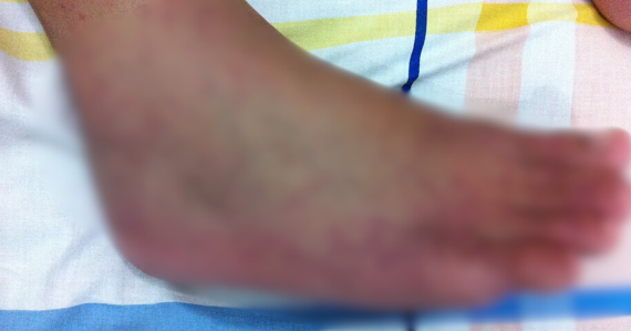 Hlásia 47-tisíc prípadov, prítomný je už všade: Krajina čelí vypuknutiu vírusovej choroby chikungunya