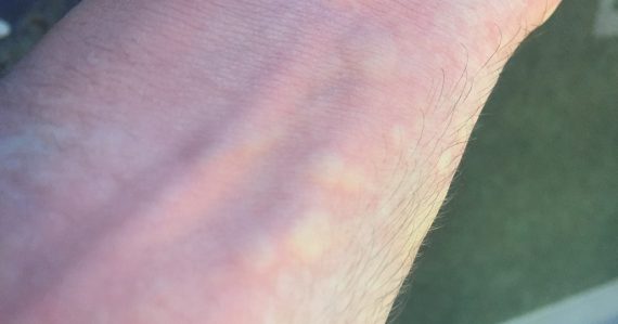 alergia na zimu, alergia na chlad, alergická reakcia