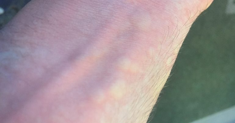 alergia na zimu, alergia na chlad, alergická reakcia