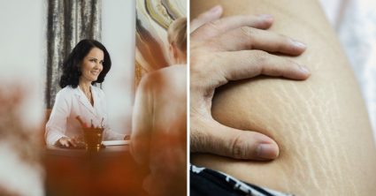 Trápia vás strie? Dermatologička radí: Odstrániť sa dajú na 85 %, dôležitý je jeden detail