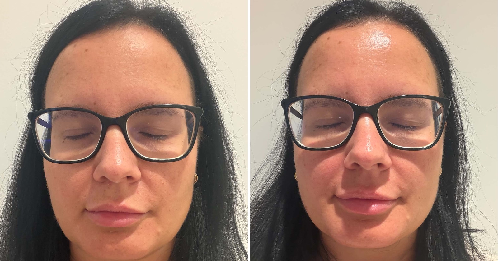 Pleť po Hydrafacial